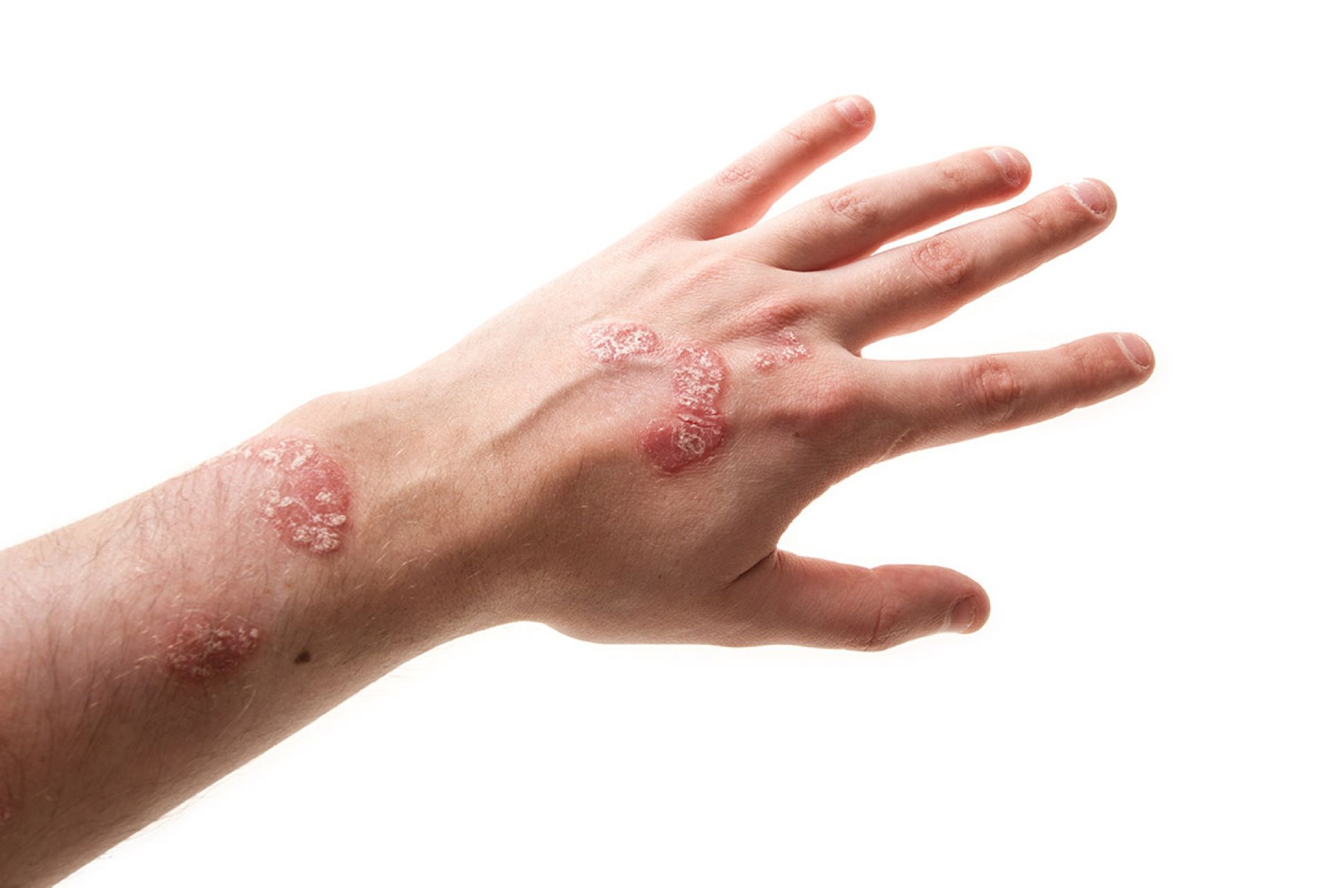 Neurodermatitis